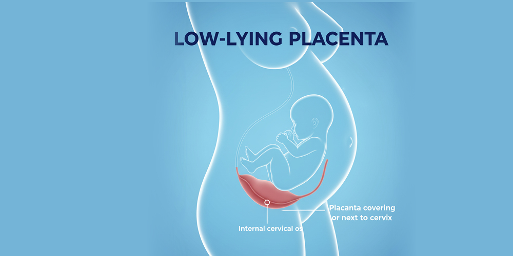 Low Lying Placenta: What Does It Mean to Have a Low-Lying Placenta?